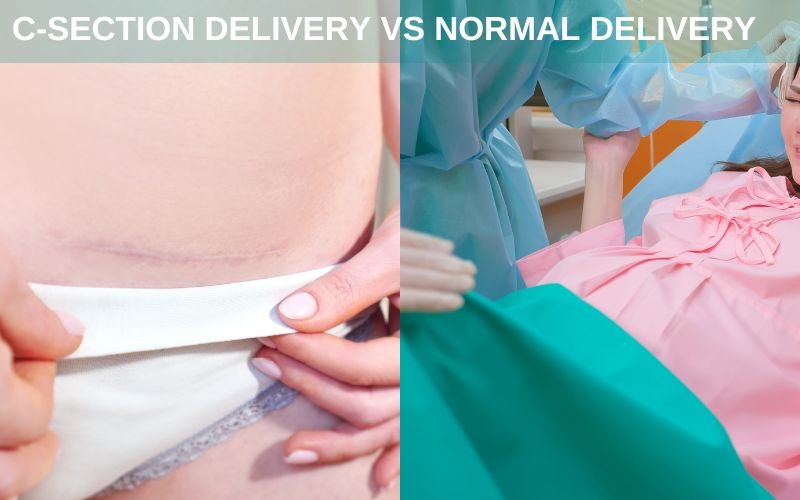 C-SECTION DELIVERY VS NORMAL DELIVERY