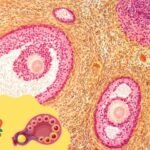 struma ovarii treatment