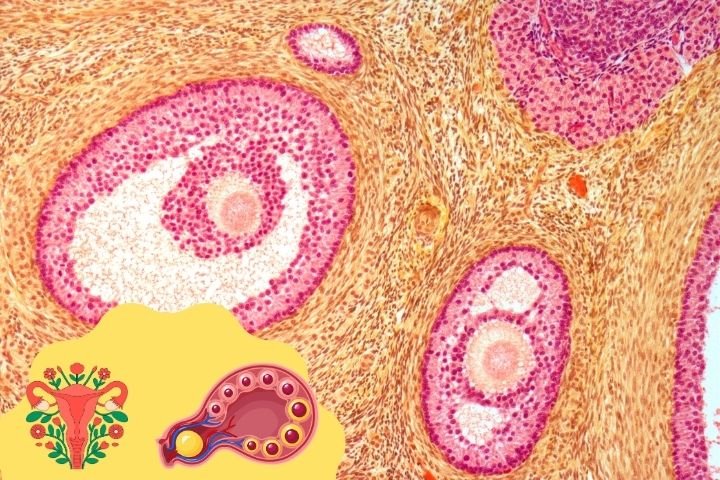 struma ovarii treatment